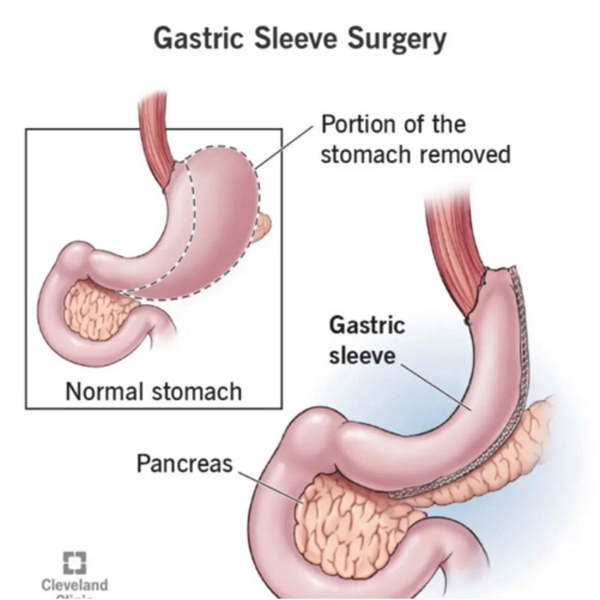 Artwork for Living with a gastric sleeve