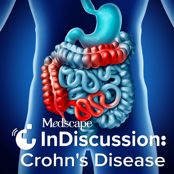 Artwork for Medscape InDiscussion: Crohn's Disease
