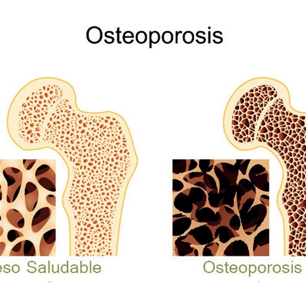 Artwork for OSTEOPOROSIS